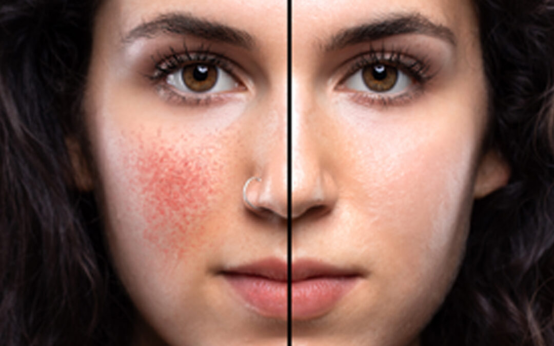 Half a face with red on her cheek and the other half of face is clear to illustrate sensitive skin